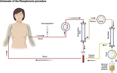 Study Protocol: A Randomized Controlled Prospective Single-Center Feasibility Study of Rheopheresis for Raynaud’s Syndrome and Digital Ulcers in Systemic Sclerosis (RHEACT Study)